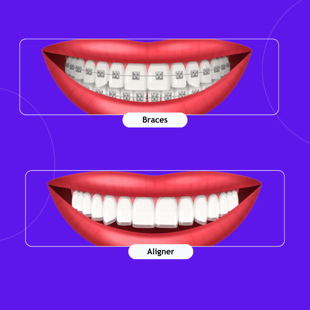 Clear Aligners Vs Metal Braces