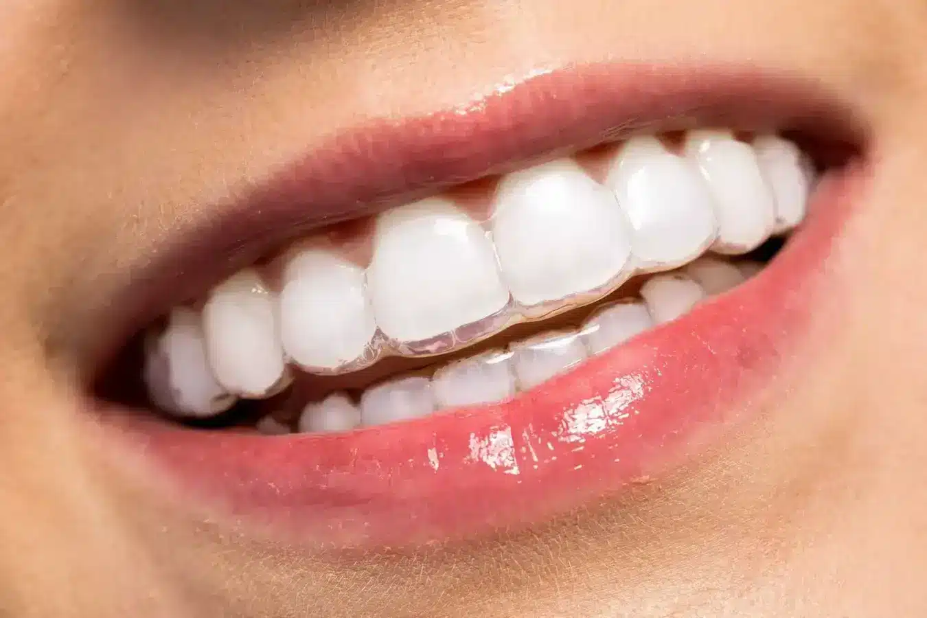 braces_types_2_fc306bd364