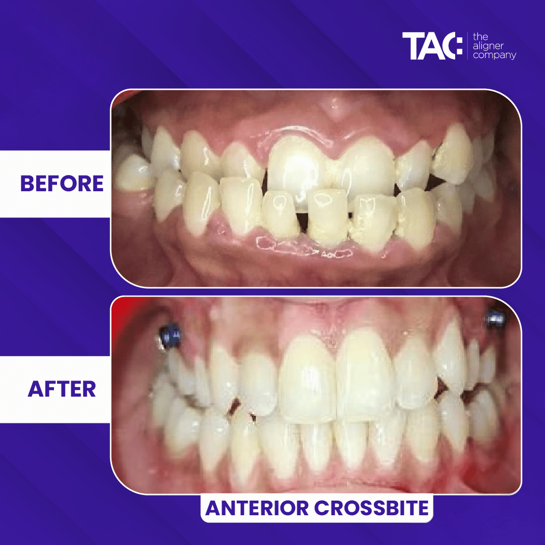 Clear aligner before after 1-1