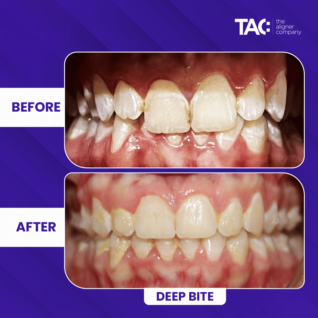 Clear aligner before after 2-2