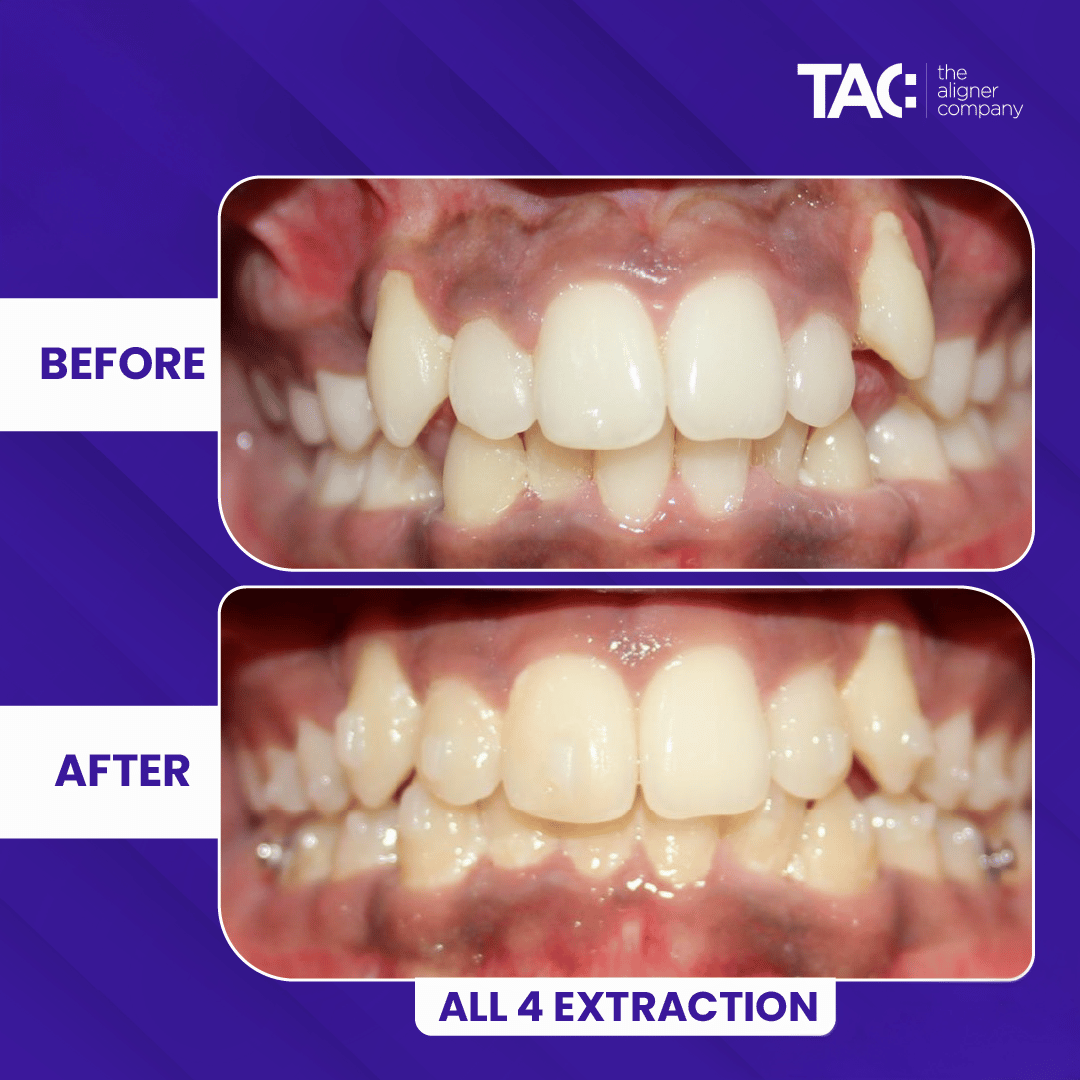 Clear aligner before after 3-3