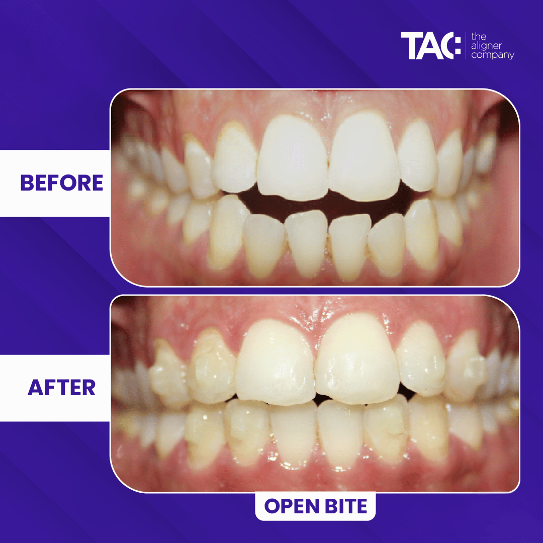 Clear aligner before after 4-4