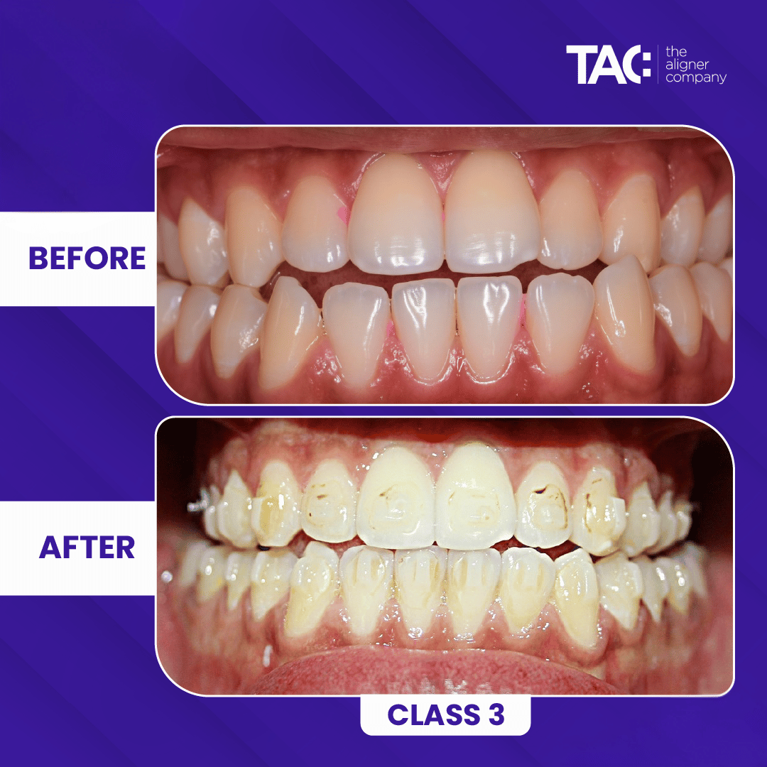 Clear aligner before after 5-5
