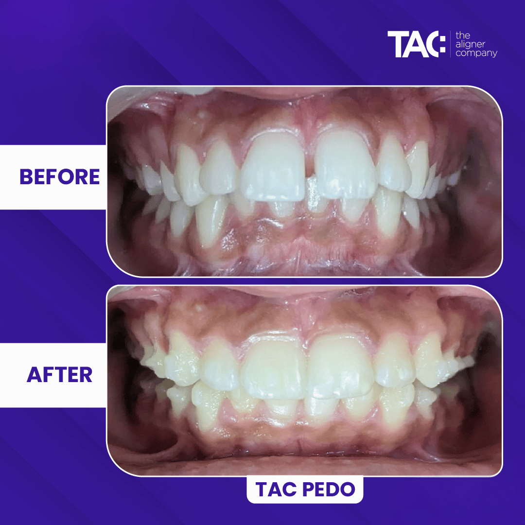 Clear aligner before after 6-6